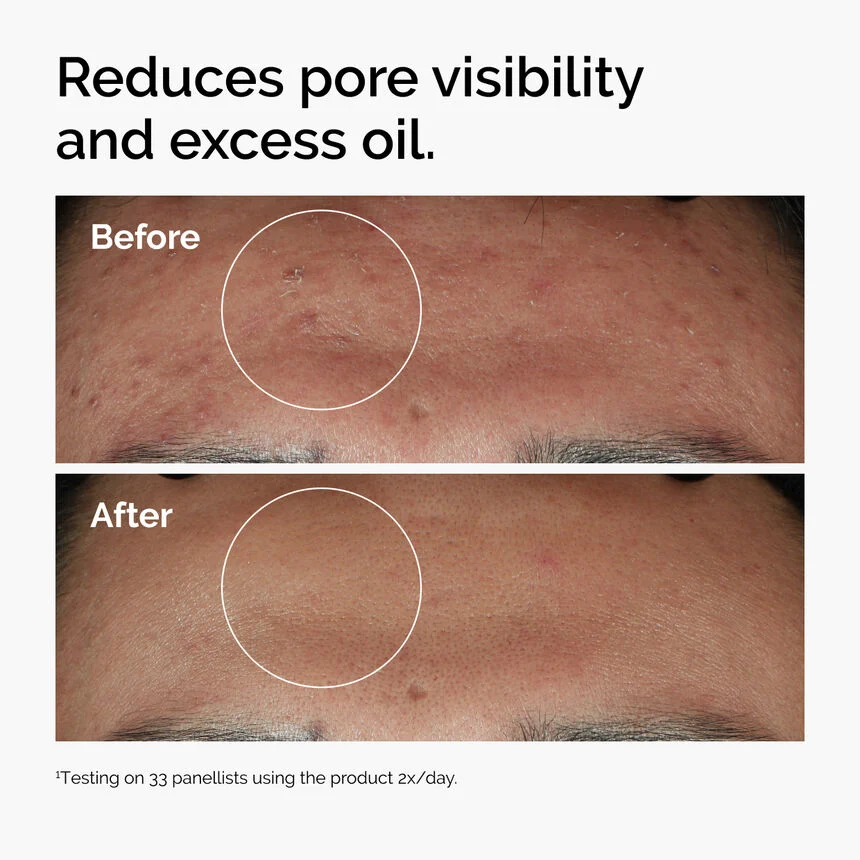 ord-niacinamide-zinc-blemish-serum-before-after-pores.webp The Ordinary Niacinamide 10% + Zinc 1% - Image 2
